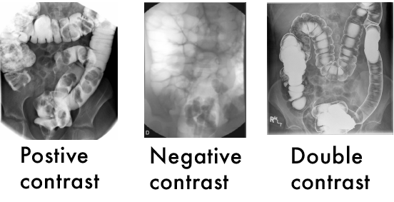 Barium Enema Examples